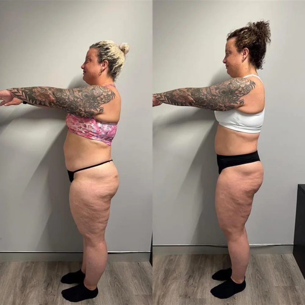 Before and after, side view: fat loss journey